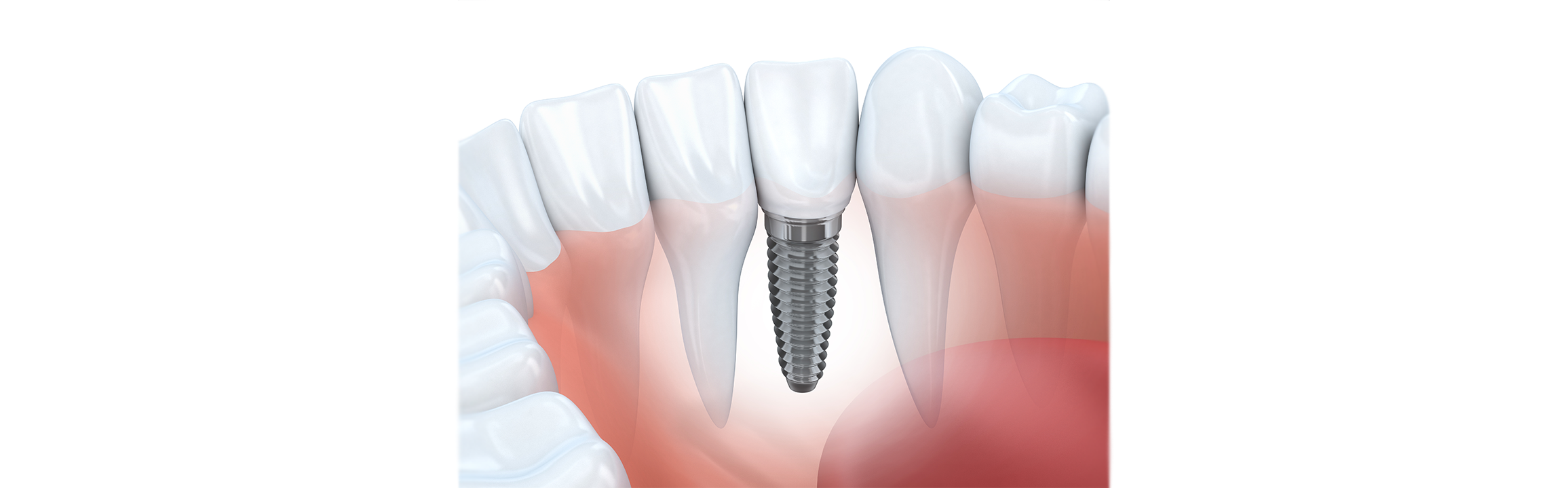 Will Your Dental Implants Change Over Time?
